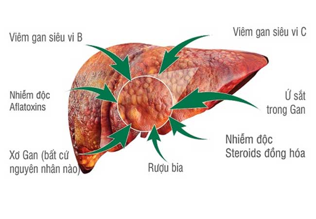 các bệnh vàng da vàng mắt