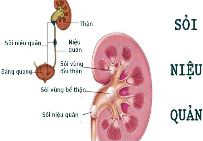 hạt đười ươi trị sỏi thận mật