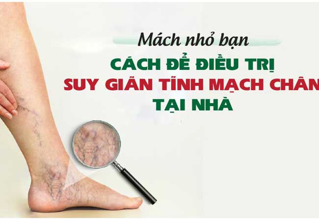 suy giãn tĩnh mạch