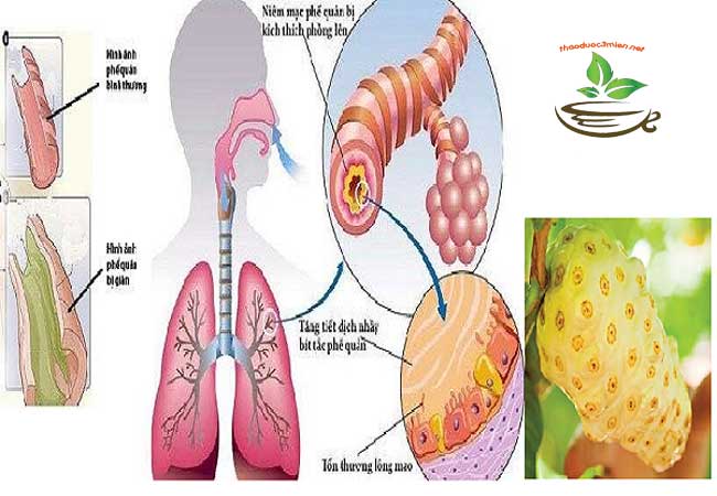 trái nhàu trị hen suyễn amidan